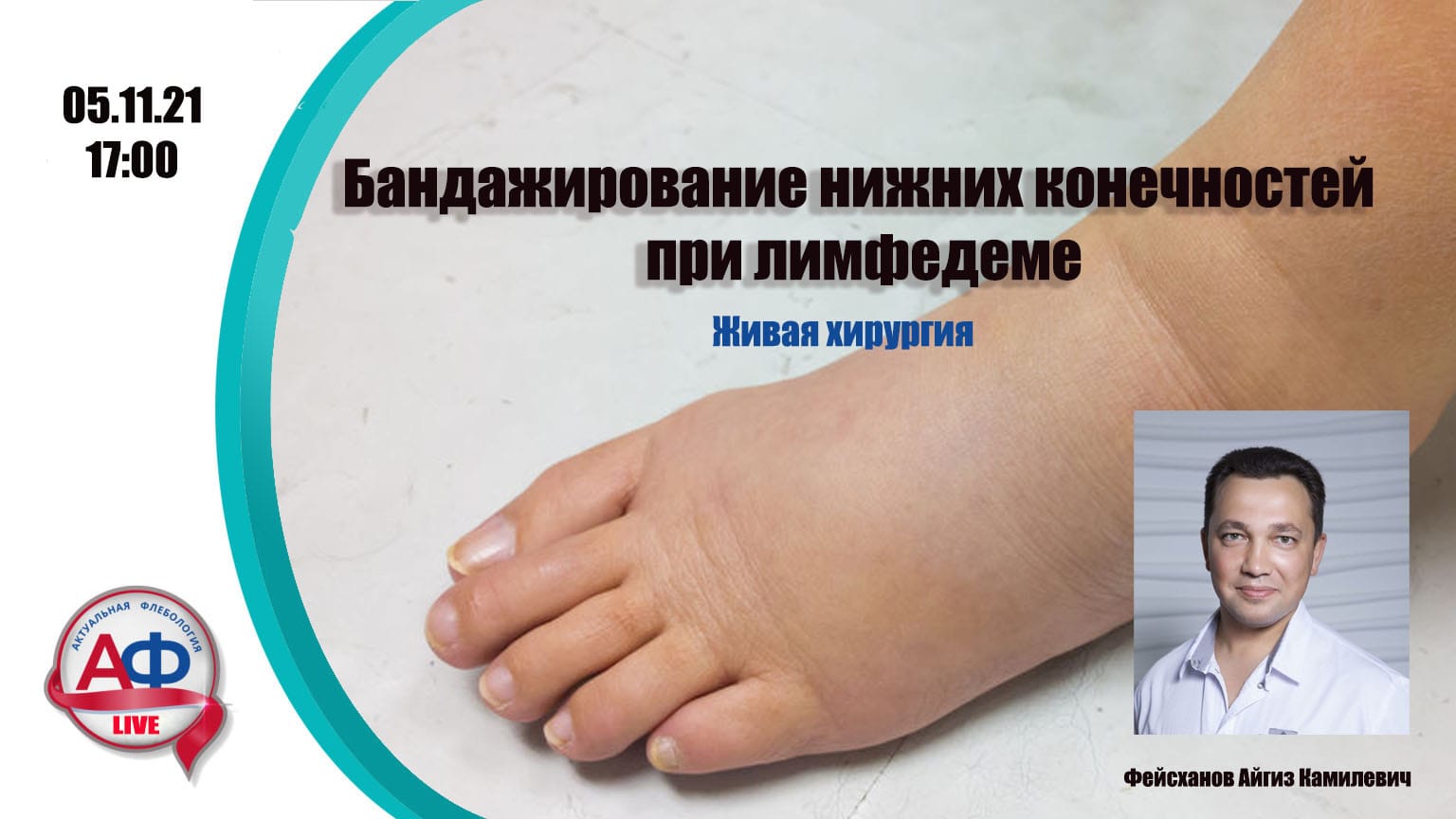 Бандажирование нижних конечностей при лимфедеме