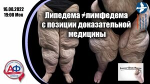 Липедема не равно лимфедема с позиций ЕВМ - Актуальная Флебология