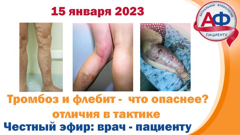 Тромбоз и тромбофлебит — что страшнее