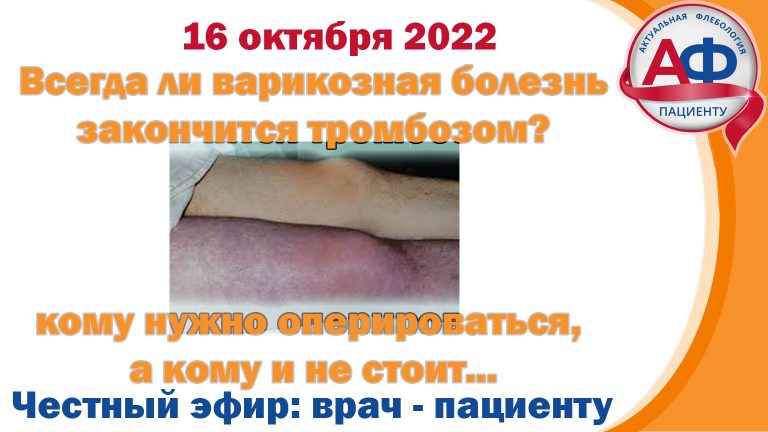 Варикозные вены — всегда ли будет тромбоз?
