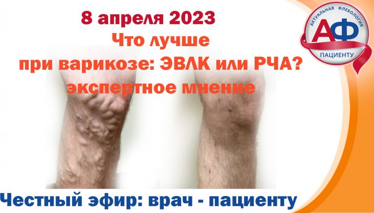 Что лучше при варикозе: лазер или радиочастота: экспертное мнение