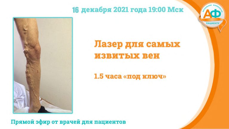 Лазер для извитых вен