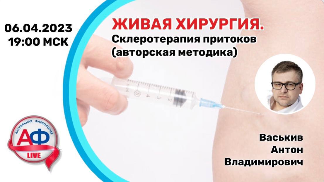 Склеротерапия притоков (авторская методика)