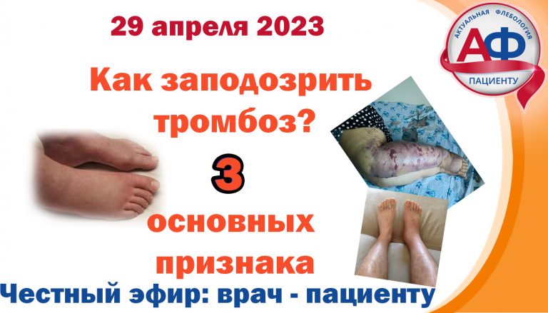 Как заподозрить тромбоз. 3 основные признака!
