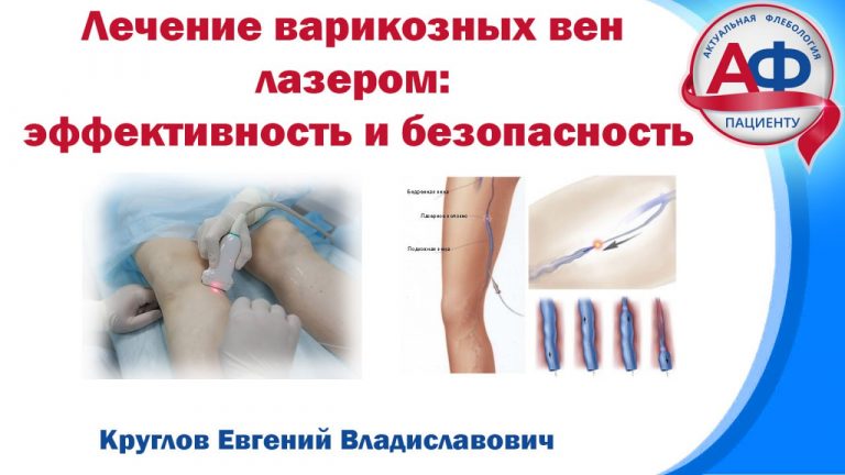 Лечение варикоза лазером