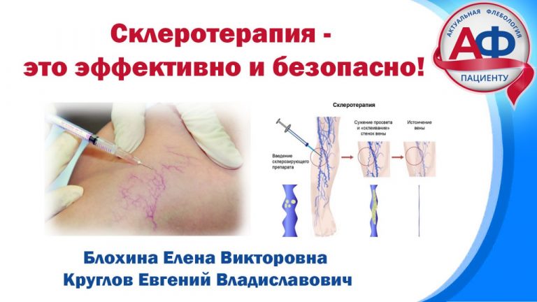 Склеротерапия: эффективно и безопасно