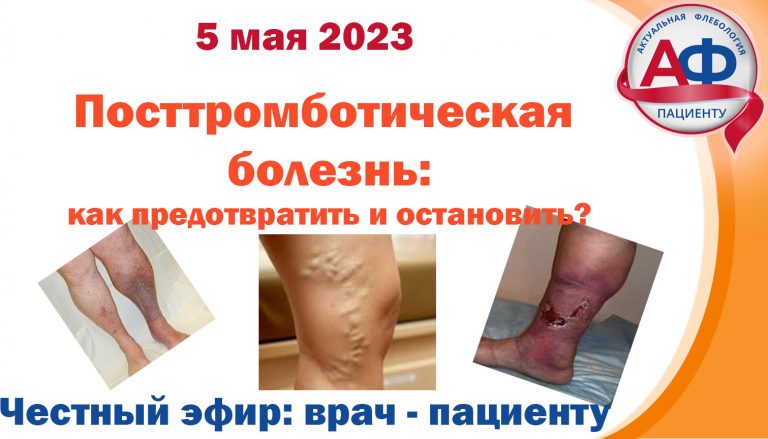 Посттромботическая болезнь  Как предотвратить и остановить?