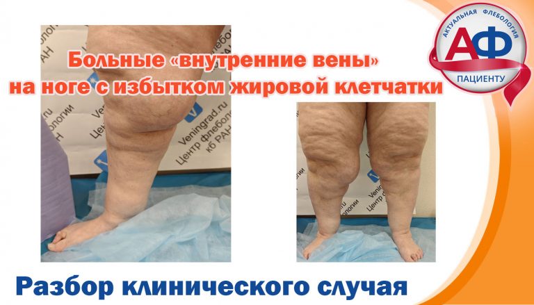 Больные «внутренние вены» на ногах с избытком жировой клетчатки.