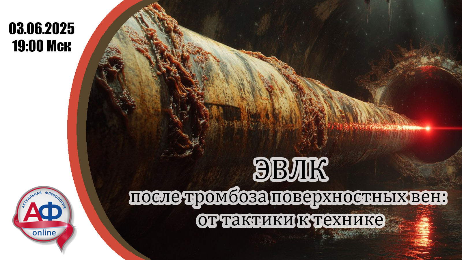 ЭВЛК после тромбоза поверхностных вен: от тактики к технике