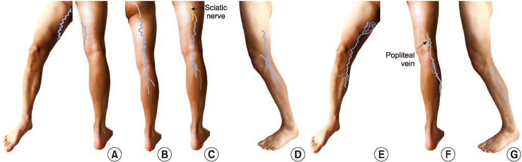 Распространенность и клиническое значение несафенного венозного рефлюкса с варикозом вен малого таза и без него