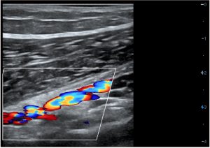 несафенном варикозе