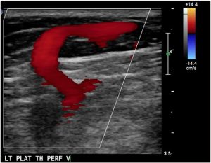 несафенный рефлюкс