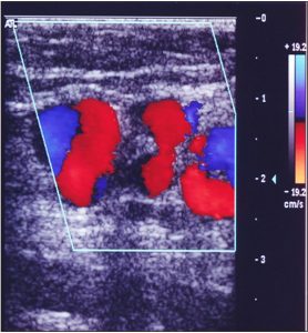 несафенном варикозе