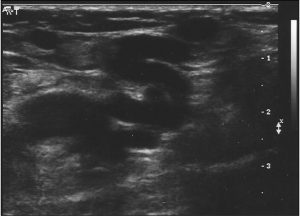 несафенного варикоза