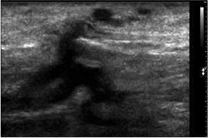 несафенный варикоз