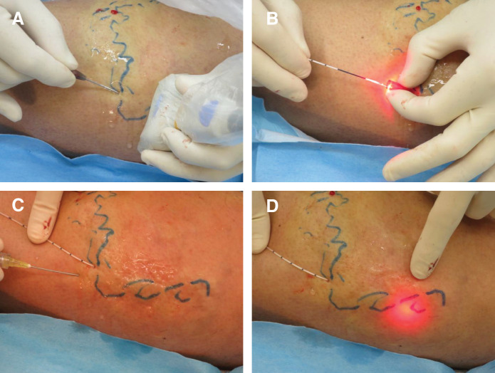 лазерная коагуляция притоков