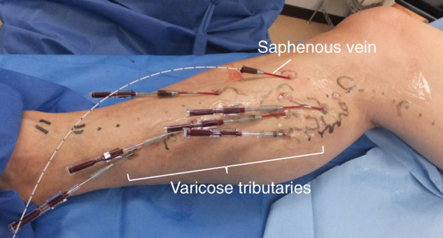 Лазерная облитерация варикозных притоков: взгляд японских коллег