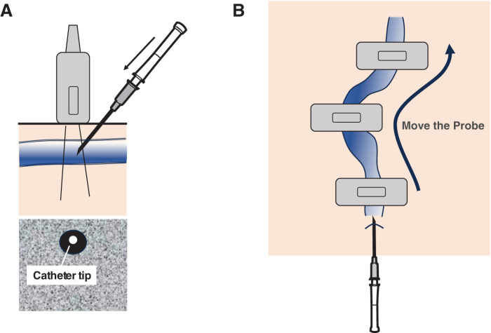 лазерная коагуляция