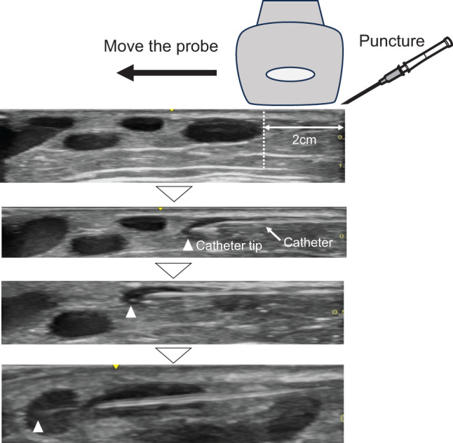 лазерная облитерация притоков
