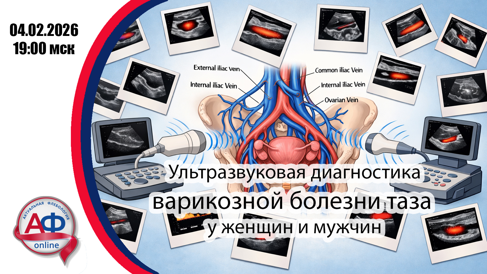 льтразвуковая диагностика варикозной болезни таза у женщин и мужчин