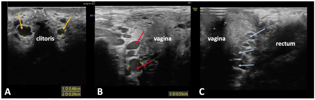 тазовый варикоз
