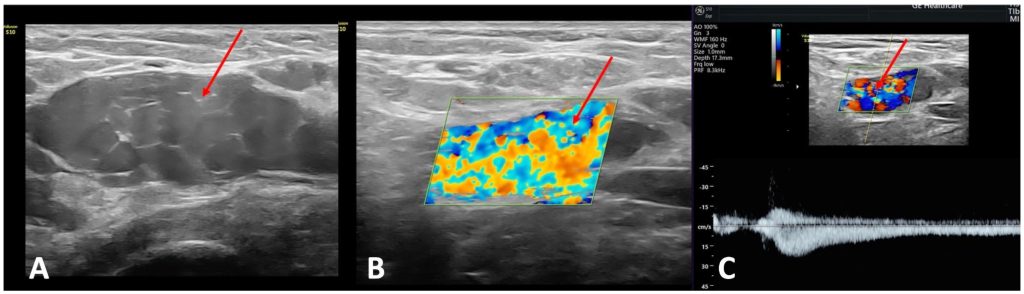 Лечение варикозных вен тазового происхождения у пациенток