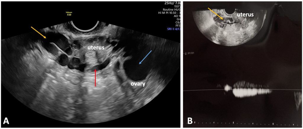 тазовый варикоз