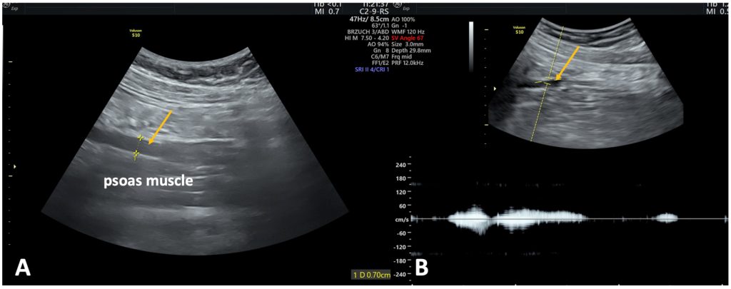 Лечение варикозных вен тазового происхождения у пациенток