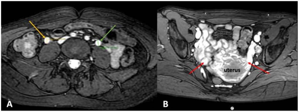 Лечение варикозных вен тазового происхождения у пациенток