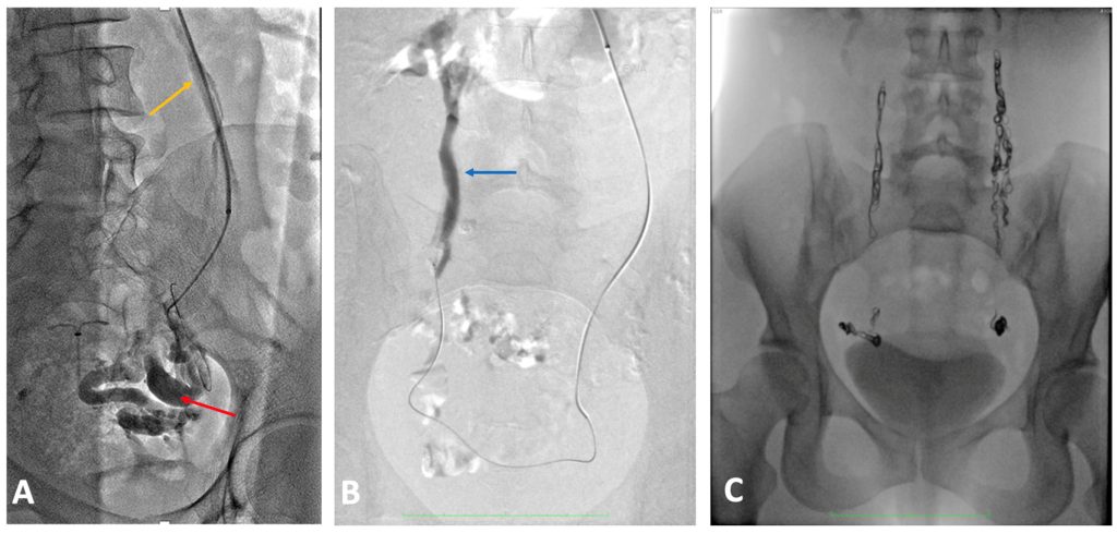 тазовый варикоз