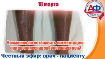 Возможно ли остановить пигментацию при хронических заболеваниях вен?