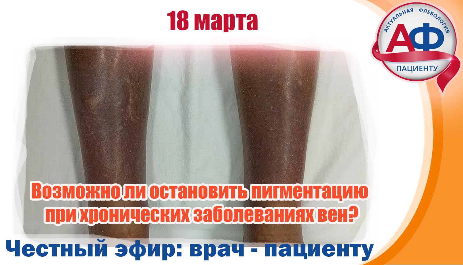 Статья - Возможно ли остановить пигментацию при хронических заболеваниях вен?