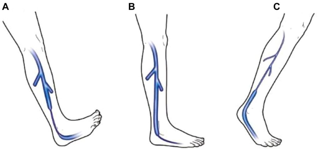 Влияние статодинамических нарушений стопы на гемодинамику нижних конечностей по данным плетизмографии