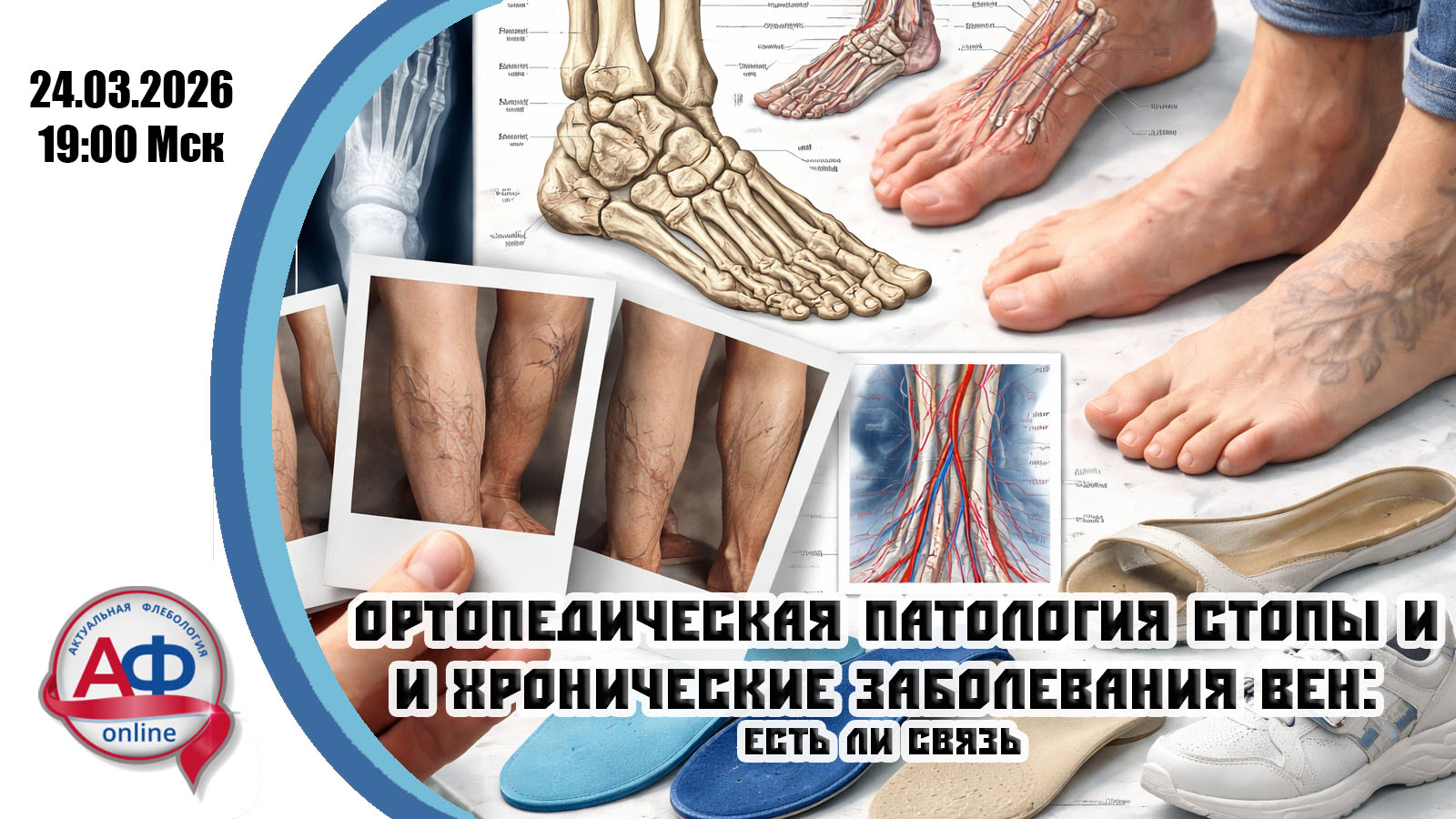 Ортопедическая патология стопы и хронические заболевания вен: есть ли связь
