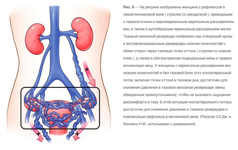 Диагностика и лечение заболеваний тазовых вен: обзорная статья экспертной группы AJR