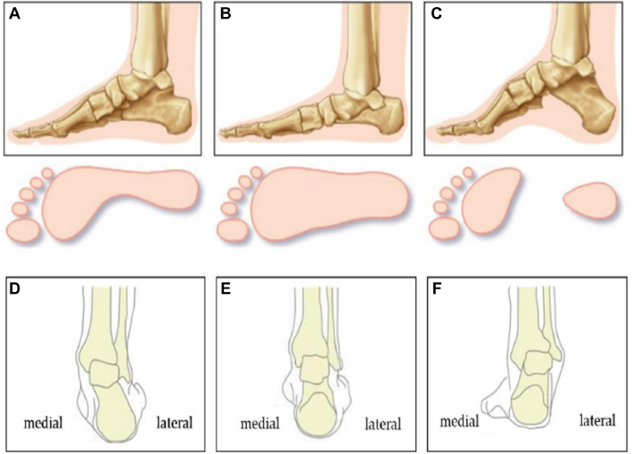 Влияние статодинамических нарушений стопы на гемодинамику нижних конечностей по данным плетизмографии