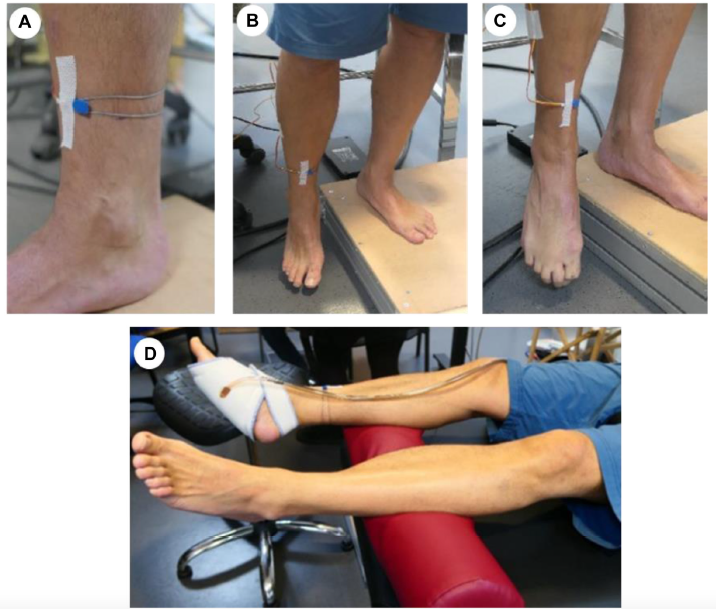 Влияние статодинамических нарушений стопы на гемодинамику нижних конечностей по данным плетизмографии