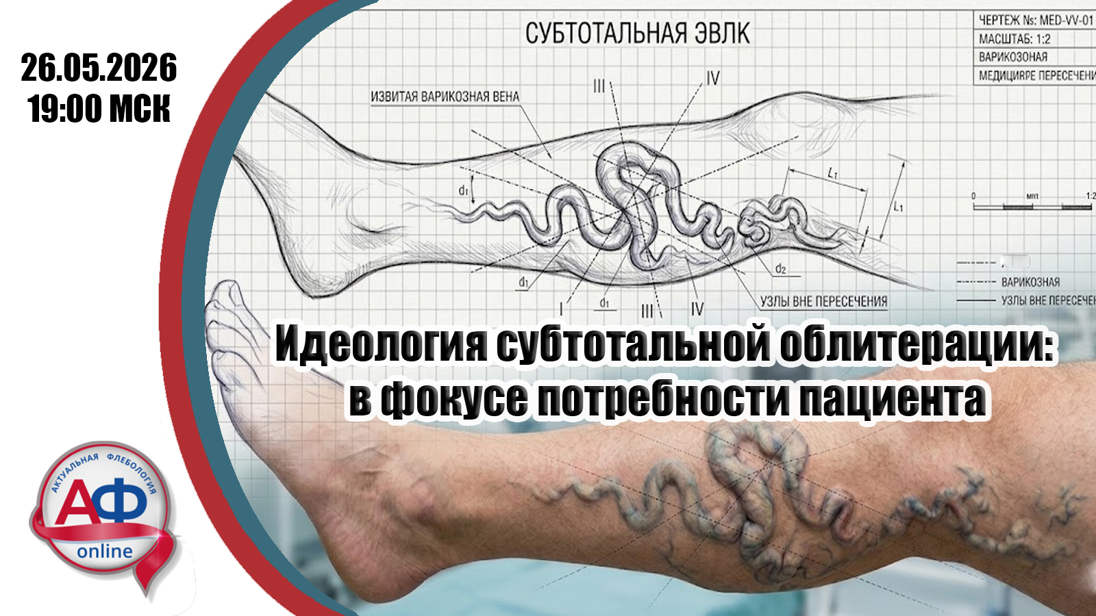 Идеология субтотальной облитерации: в фокусе потребности пациента