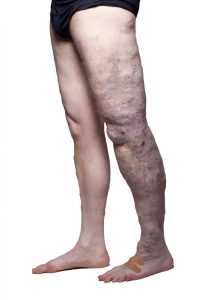 Vascular malformations: