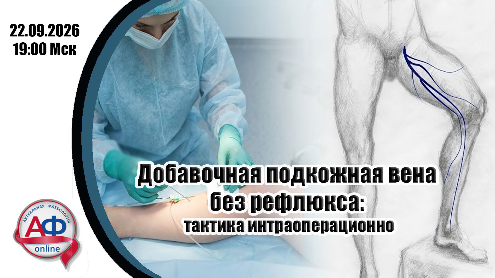 Добавочная подкожная вена без рефлюкса: тактика интраоперационно
