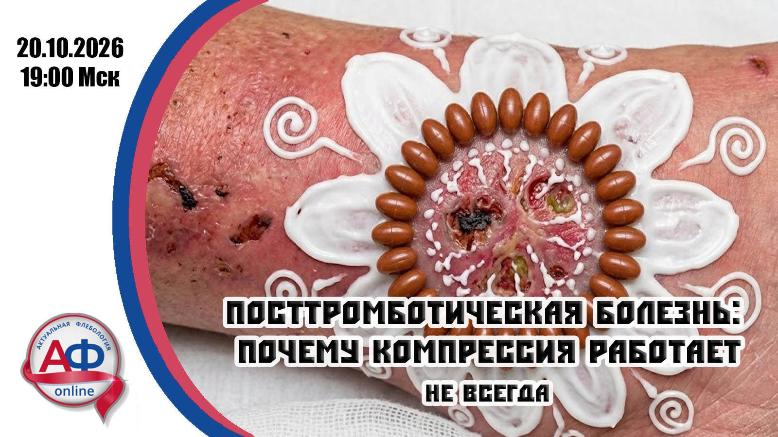 Посттромботическая болезнь: почему компрессия работает не всегда